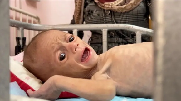 Kazem Abu Khalaf precisó que la cifra de niños y niñas que han alcanzado un estado de desnutrición severa ha aumentado en 180 por ciento
